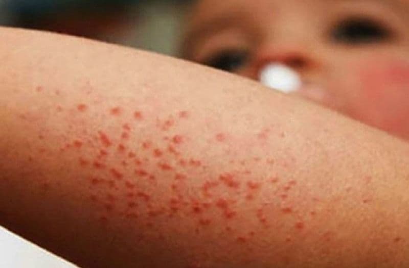 Preocupa a epidemiólogo de la UASLP aumento de casos de sarampión en México