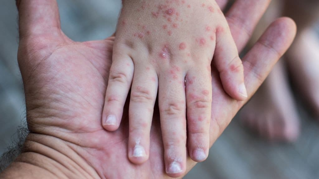 Descartan brote de sarampión en SLP