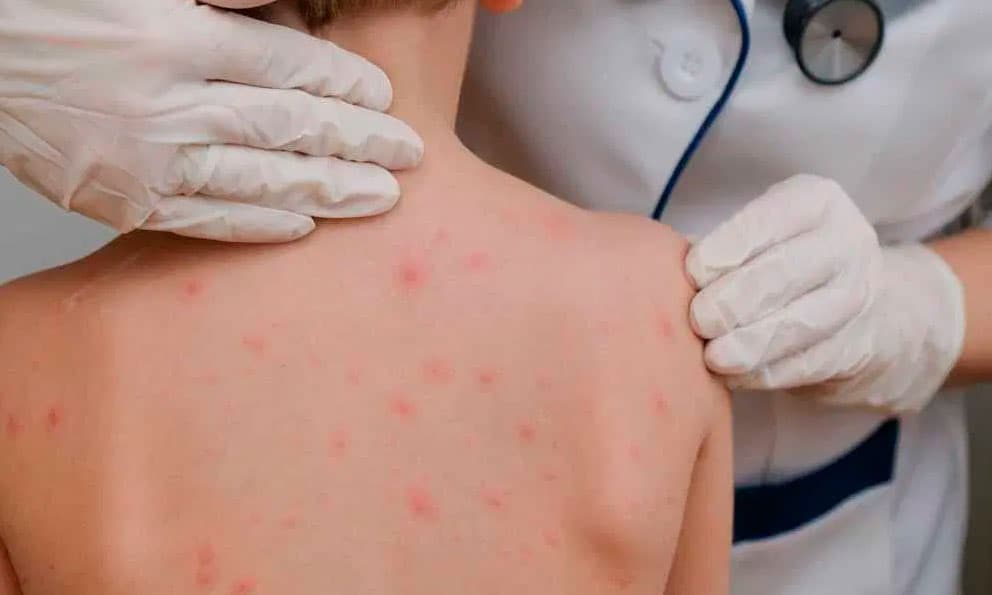 Suman cerca de 5 mil casos de sarampión en el país