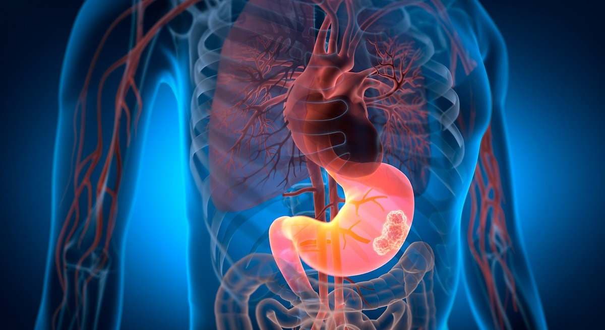 Tienen 7 de cada 10 mexicanos bacteria relacionada con cáncer gástrico