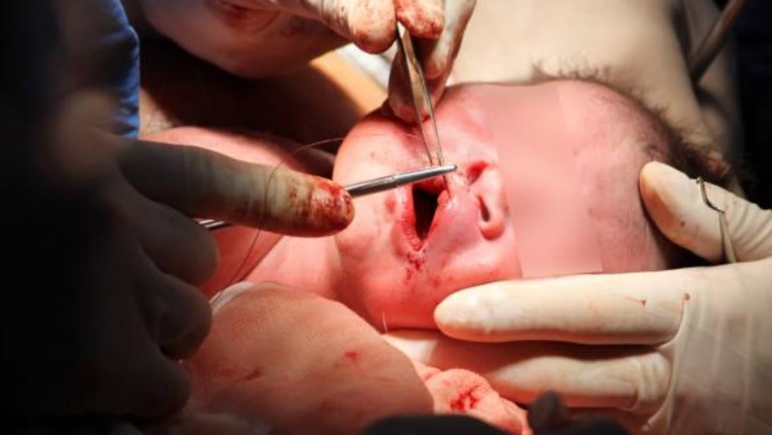 Proyecta Salud ampliar programa de cirugías para niños con Labio Leporino