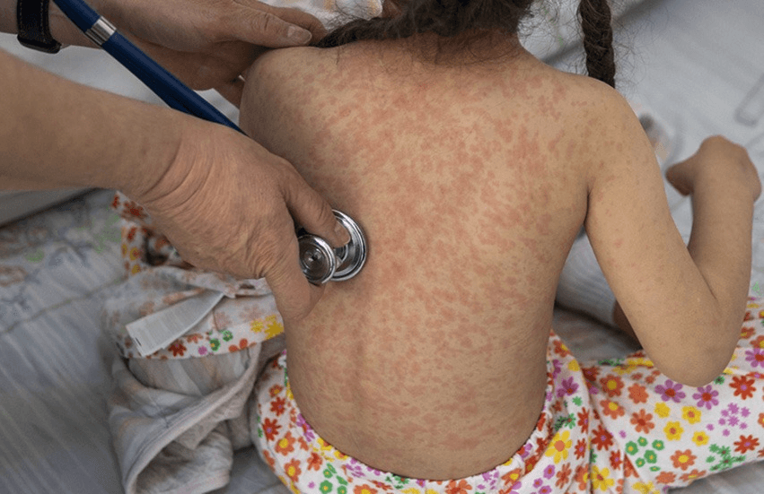 Repuntan casos de Sarampión en el Estado: Secretaría de Salud