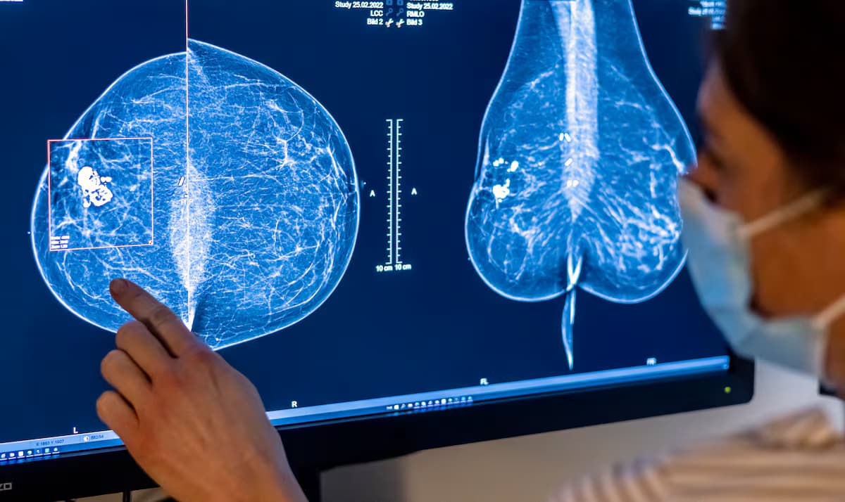 IA mejora la detección temprana del cáncer de mama en estudios clínicos