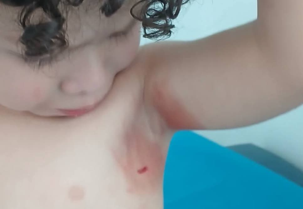 Queman con mercurio a niño en guardería en Ciudad Valles